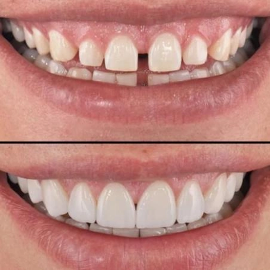 Вініри зубні Perfect Smile Veneers змінні White PerfectSmile фото