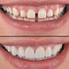 Вініри зубні Perfect Smile Veneers змінні White PerfectSmile фото 4